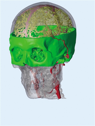 看了这3D打印模型 是不是感觉医生更有底