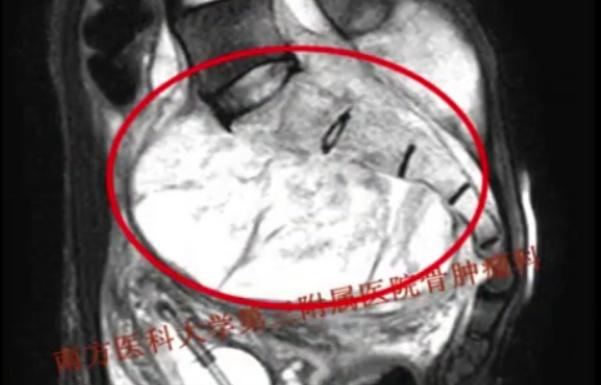 男子身體被“腰斬”3D打印技術(shù)來(lái)連接 使無(wú)數(shù)患者燃起新希望