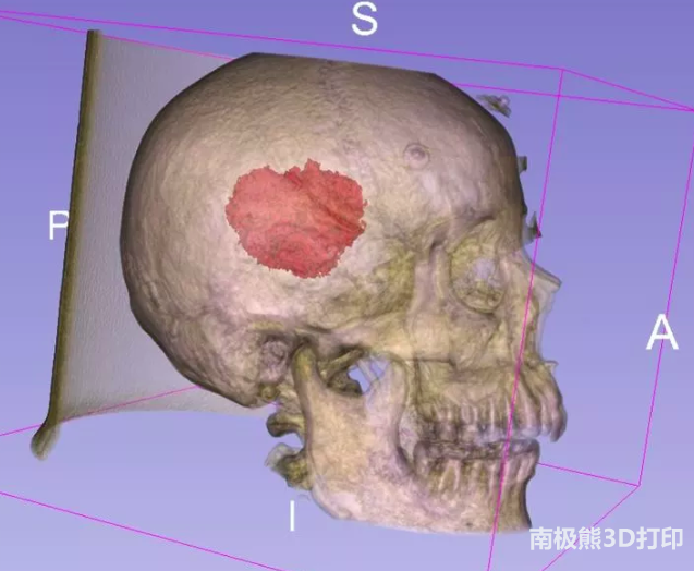 3D-slicer3Dӡ弼ٴ