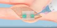 3D Systems联合TISSIUM获FDA批准，首创3D打印无缝线神经修复技术