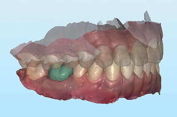 Align Technology推出iTero套件，为牙科假体3D打印设计提供直观方案